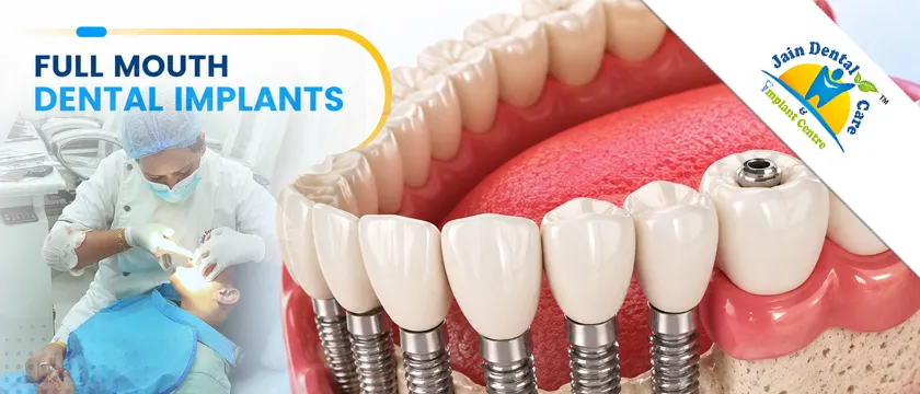 Dental Implants in Raipur